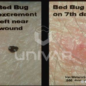 Bed Bug Bite & Excriment